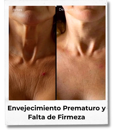 L prematuro
